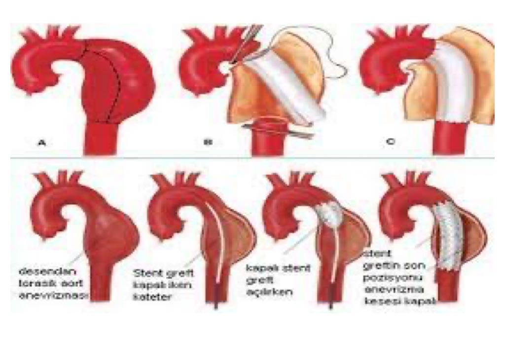 Thoracic and Abdominal Aortic Aneurysm